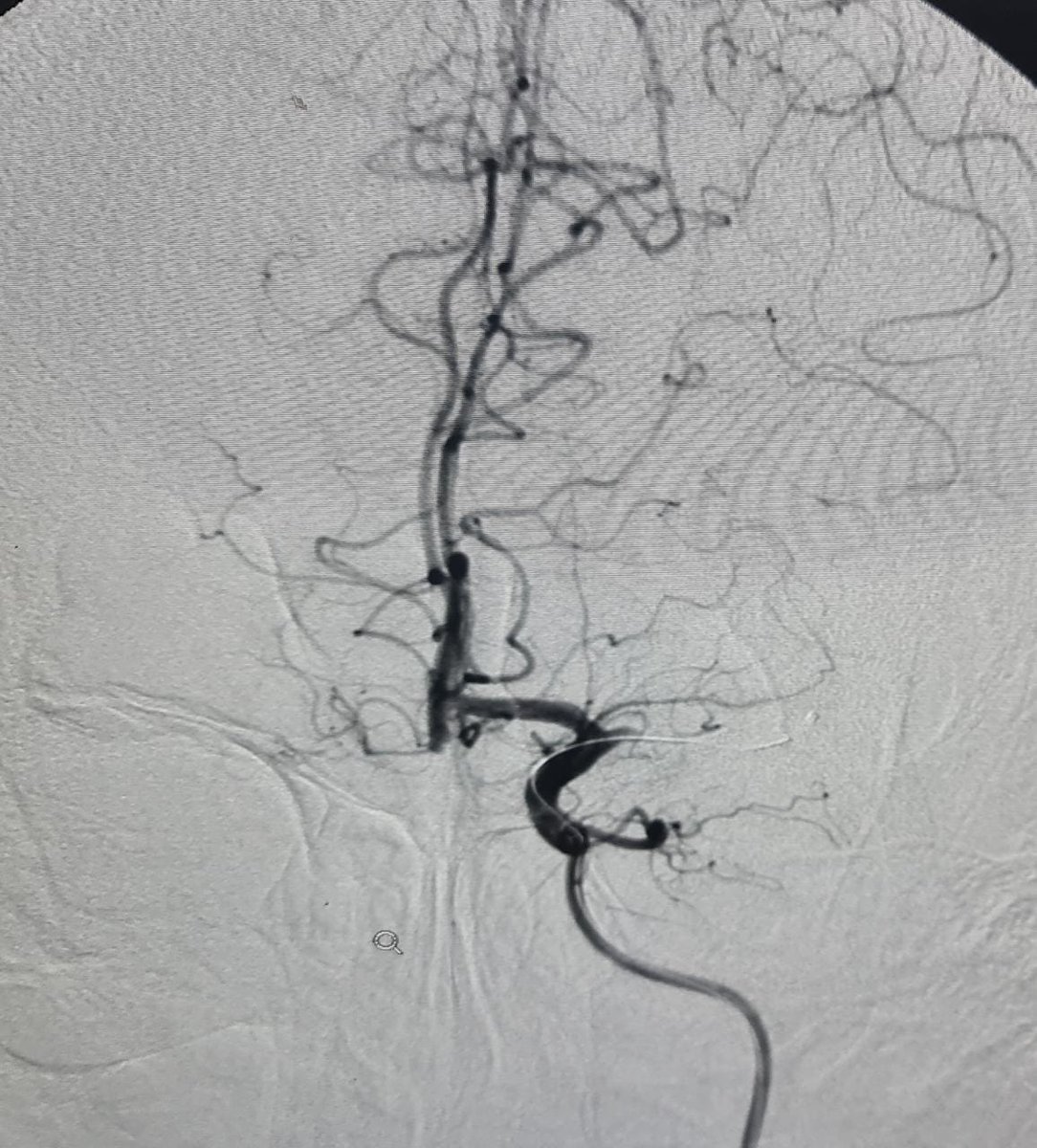 PenNeuro's tweet image. OUS HCPs: #RED72 case by @PraveshRaj75 out of Annapurna Neurological Institute &amp;amp; Allied Sciences, Nepal: Single Pass, 35 mins to revascularization! #REDglideDifference Rx only. For risk info: bit.ly/37YcYIU Clinical result may vary.
