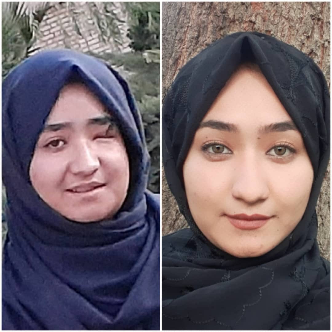 MukhtarModabb's tweet photo. برای فاطمه که یک چشمش را از دست داده و بازهم میخواهد درس بخواند ،نگران چشم ،درس و اینده اش است. 
برای پیوند چشم مصارف زیاد نیاز است و نیاز به همکاری تمام دوستان.
لطفا همرسانی کنید
#StopHazaraGenocide https://t.co/zuLrV3xnGa
