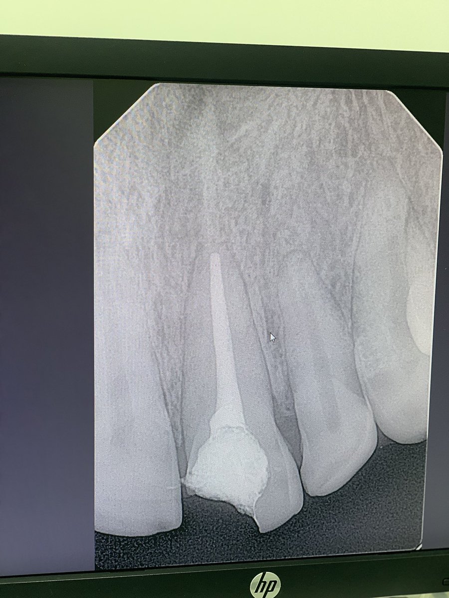Khaled (@khaledwaleed64) on Twitter photo #21 open apex
Dx: Pulp necrosis with normal apical tissue
Supervised by prof ahmed alkahtani <a href="/DrKahtani/">أحمد بن مبارك</a> #21 open apex
Dx: Pulp necrosis with normal apical tissue
Supervised by prof ahmed alkahtani <a href="/DrKahtani/">أحمد بن مبارك</a>