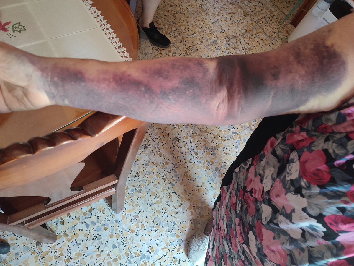 EstherGarcia02's tweet photo. Mi abuela el pasado martes acudió a las urgencias del hospital clínico de Málaga, se realizo un análisis de sangre en la consulta 12 por la enfermera adjunta a dicha consulta y el resultado es el abrazo morado desde la axila hasta los dedos. 
Ojalá llegue este tweet al hospital https://t.co/YXN1kZo5PU