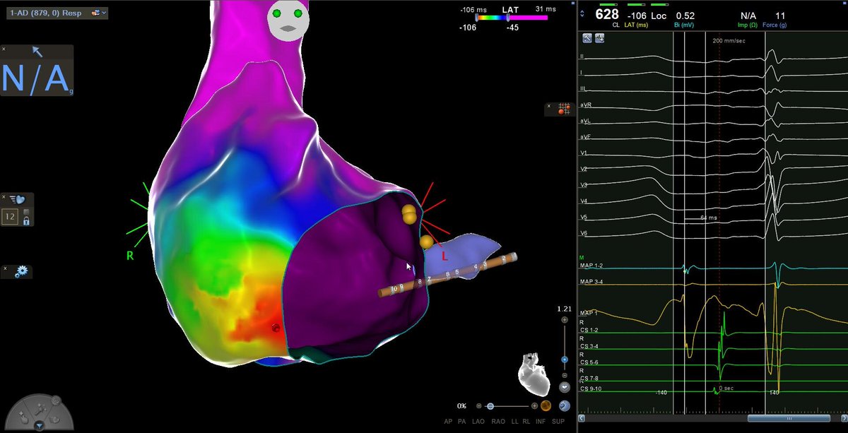David González Casal (@davidgzcasal) on Twitter photo Focal atrial tachycardia arising from the inferolateral tricuspid annulus. Atrial activation in the ablation site precedes the P wave onset by 64 ms. #EPeeps <a href="/TomasDatino/">@TomasDatino</a> <a href="/jacabreracardio/">Dr. José Ángel Cabrera</a> <a href="/NinaSoto1/">NinaSoto</a> <a href="/jg_panizo/">Jorge G Panizo, MD</a> Focal atrial tachycardia arising from the inferolateral tricuspid annulus. Atrial activation in the ablation site precedes the P wave onset by 64 ms. #EPeeps <a href="/TomasDatino/">@TomasDatino</a> <a href="/jacabreracardio/">Dr. José Ángel Cabrera</a> <a href="/NinaSoto1/">NinaSoto</a> <a href="/jg_panizo/">Jorge G Panizo, MD</a>