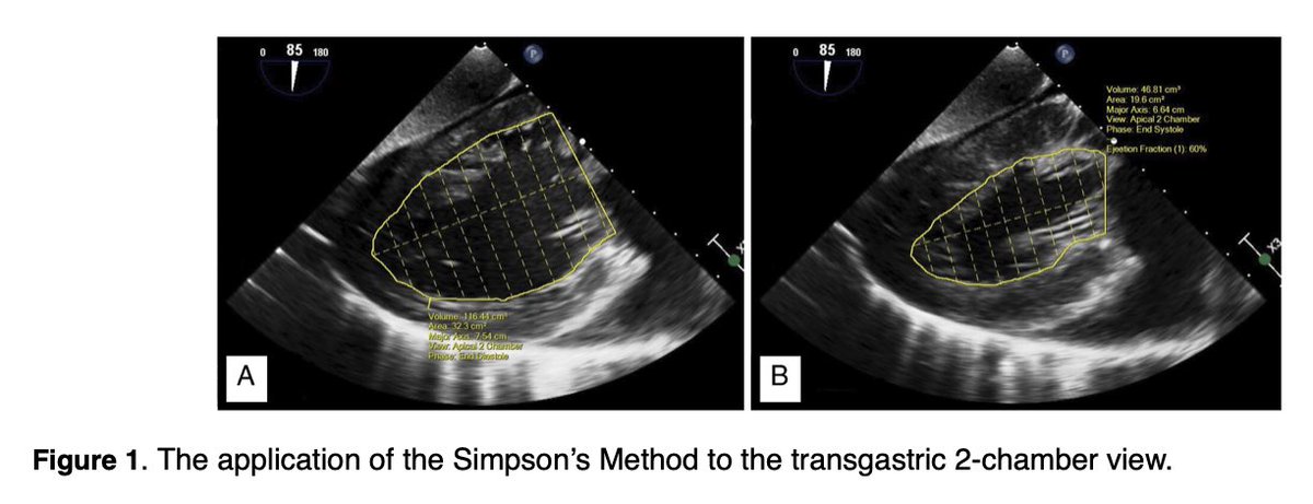 Simpson’s method can be applied to the transgastric 2 chamber view as an alternative to the standard midesophageal method to estimate chamber volumes and EF. #echofirst journals.sagepub.com/doi/epub/10.11…