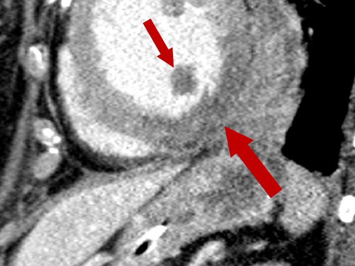 Few weeks ago I showed an acute MI on CT during lecture. Said they would probably not see this again depending on where they go

Well you know how that goes, shortly after this pops up!!🫠

STEMI ➡️ Low attenuation (lack of perfusion) of the inferolateral LV wall and papillary mm