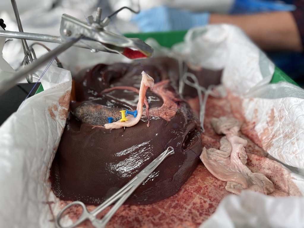 BOWAMEDICALUK's tweet photo. The second practical session gave the Delegates the opportunity to practice Hepaticojejunostomy on our wetlab models. The "Basics of Liver Surgery Course" will also cover the MDT Liver Cases Discussion and valued feedback before the end of the day. #GBIHPBA #AUGIS #ROUXGROUP #HPB https://t.co/er6yhlRt7A
