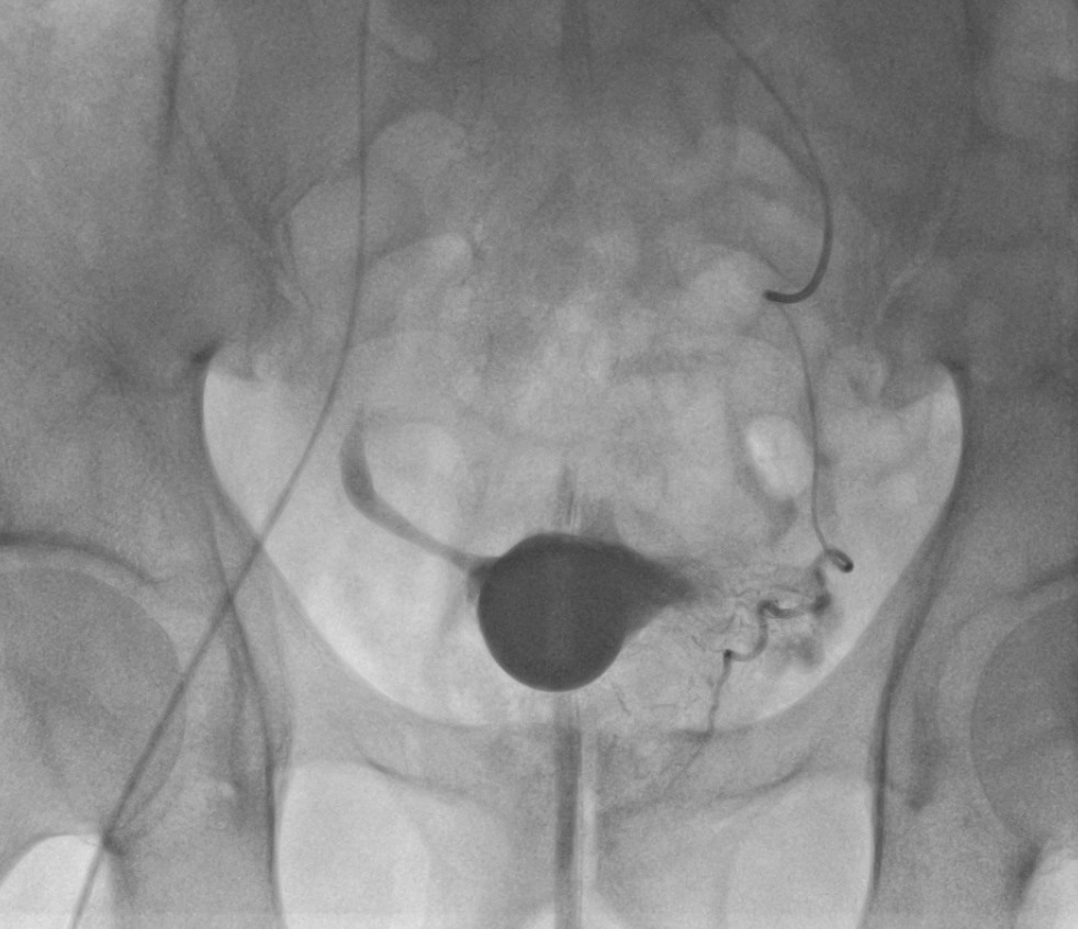 amadabadia's tweet photo. One of the most gratifying sensations...
when you finally: catheterize!
@actasurologicas @SERVEISoc @cirsesociety @Com_CHUO @terumobct
#embolizacionprostatica
#embolization
#PAE
#prostaticembolization https://t.co/rs5Ug2NBjR