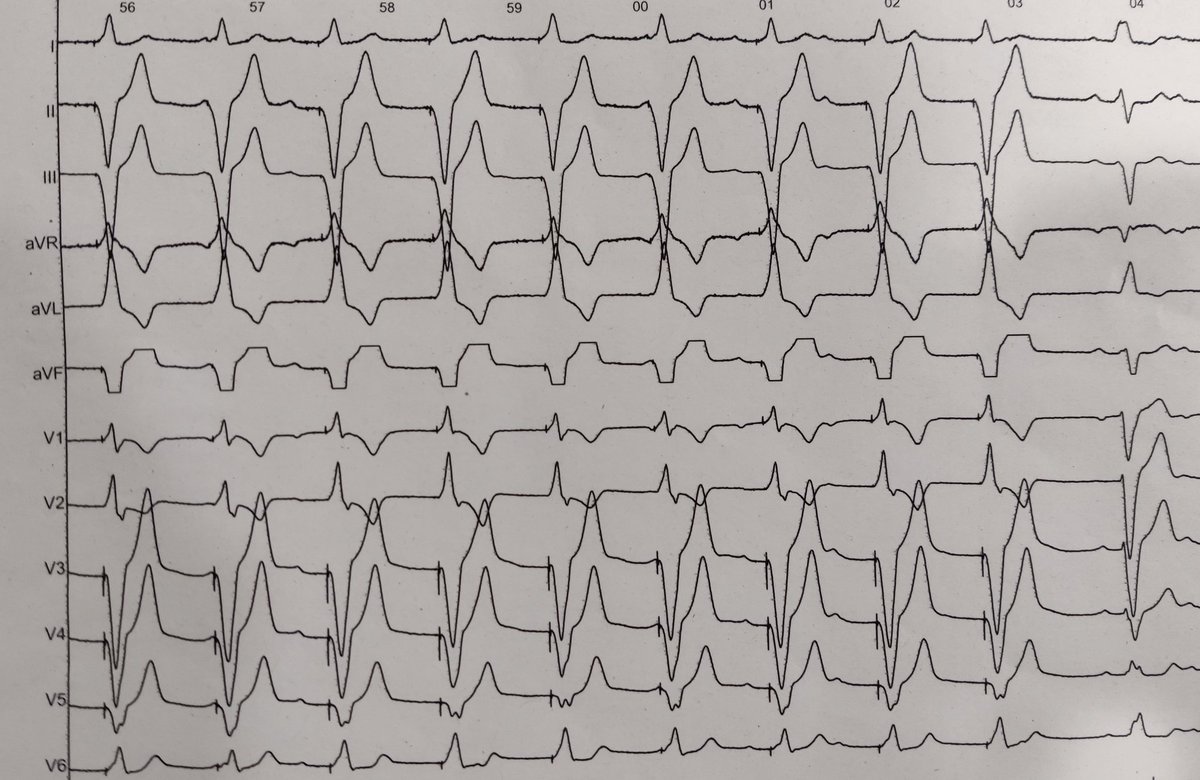 rasocardio's tweet photo. Esperando resultados con endpoints "duros" sobre la estimulación en RI. Viendo esto... ¿Alguien duda que serán positivos? Hoy en @cardioalcoi @GVAdsalcoi @SVCardio @estimcardiaca @secardiologia https://t.co/uss1xD0Lnq