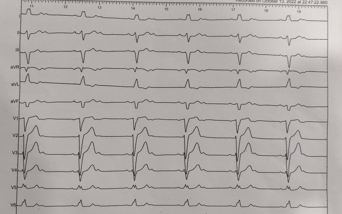 rasocardio's tweet photo. Esperando resultados con endpoints "duros" sobre la estimulación en RI. Viendo esto... ¿Alguien duda que serán positivos? Hoy en @cardioalcoi @GVAdsalcoi @SVCardio @estimcardiaca @secardiologia https://t.co/uss1xD0Lnq