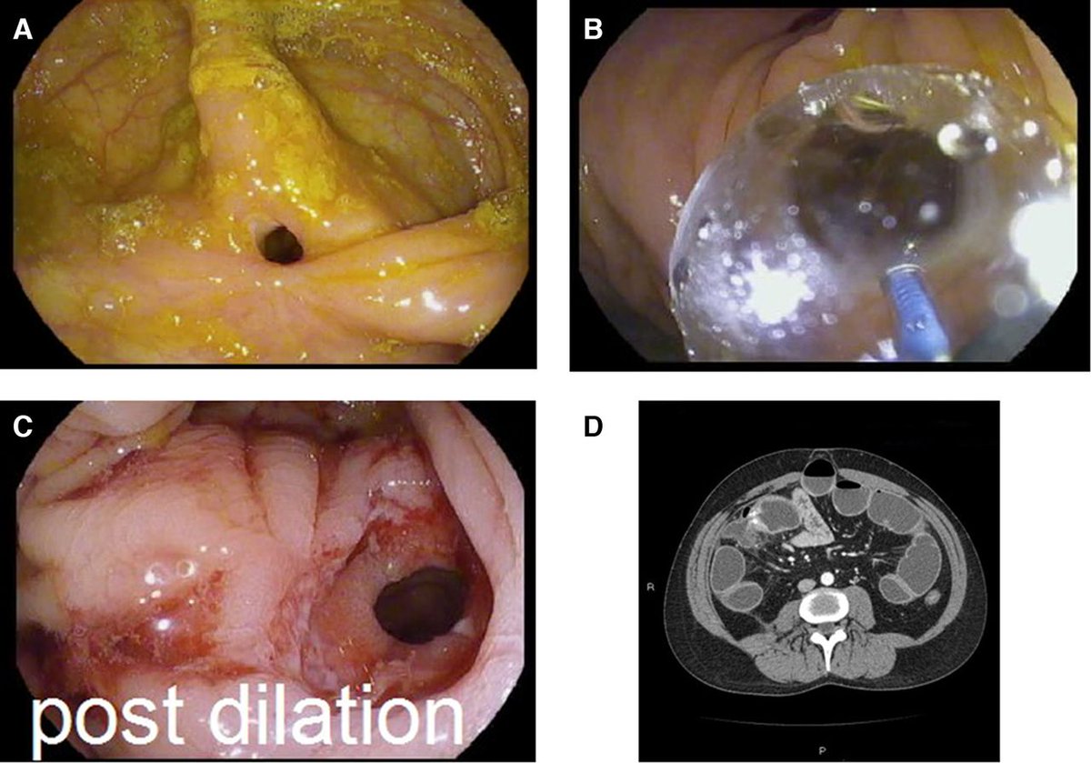 FrontGastro_BMJ's tweet photo. Read the excellent latest issue of @FrontGastro_BMJ online now via

https://t.co/X773ePSewg

or via

https://t.co/rga3mbWBVQ

#IBDTwitter #LiverTwitter #EndoTwitter #GITwitter #UEGWeek22 @RMBeattie50 @OTavabie @Dr_Dee_Kumar @drobeirne @AusDrGupta @jennie_clough @DCharabaty https://t.co/UCJ9w0DSqA