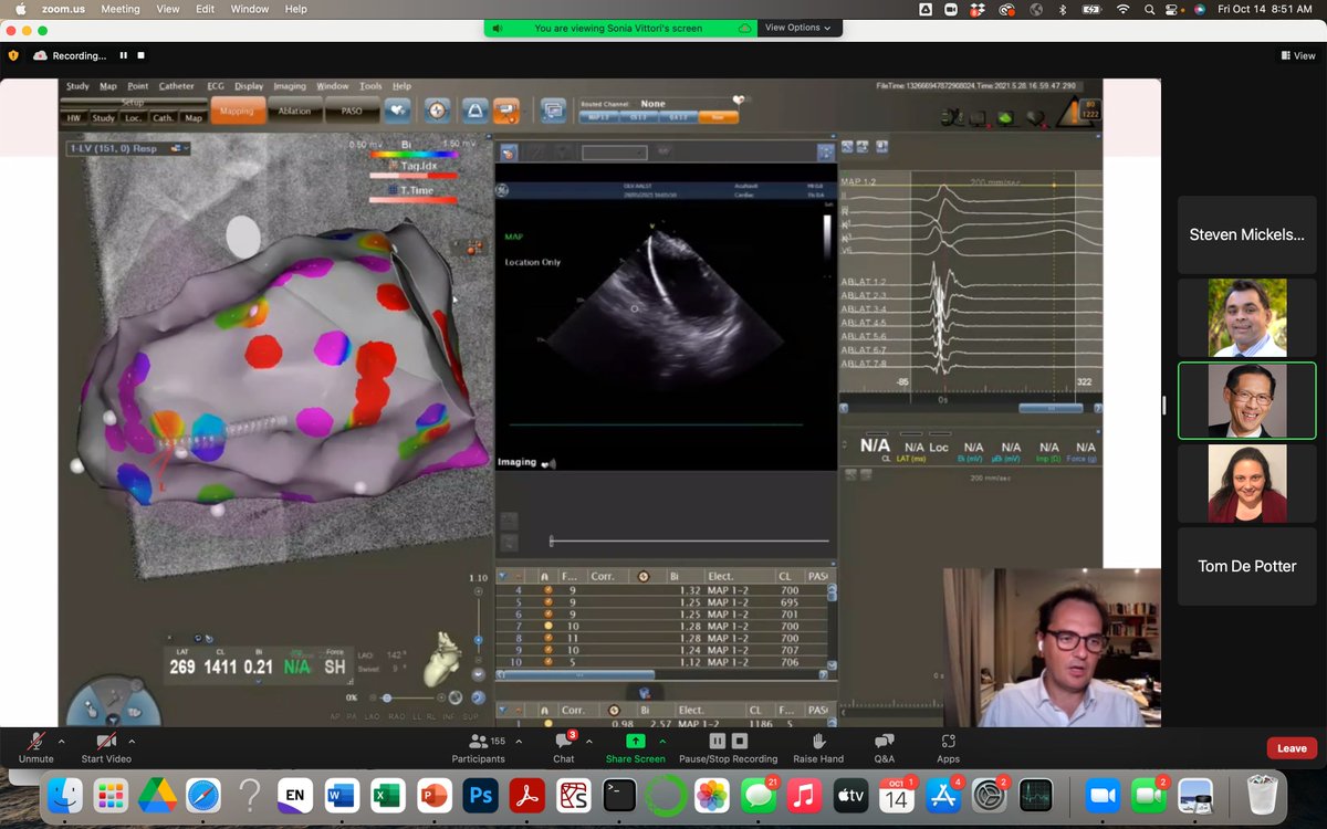 Sanjiv Narayan (@s_narayanmd) on Twitter photo First in human case presented by <a href="/tomdepotter/">Tom De Potter</a> of ultralow temperature cryoablation for #VT . One lesion ➡️elimination of high frequency, other potentials. #StanfordEP22 <a href="/AdagioMedical/">Adagio Medical</a> <a href="/jskoruth/">Jacob Koruth</a> <a href="/EladAnter/">Elad Anter</a> <a href="/atulverma_md/">Atul Verma</a> <a href="/BadhwarNitish/">Nitish Badhwar</a> <a href="/Ed_Gerst/">Edward Gerstenfeld</a> <a href="/JonPicciniSr/">Jonathan Piccini, MD, MHS</a> First in human case presented by <a href="/tomdepotter/">Tom De Potter</a> of ultralow temperature cryoablation for #VT . One lesion ➡️elimination of high frequency, other potentials. #StanfordEP22 <a href="/AdagioMedical/">Adagio Medical</a> <a href="/jskoruth/">Jacob Koruth</a> <a href="/EladAnter/">Elad Anter</a> <a href="/atulverma_md/">Atul Verma</a> <a href="/BadhwarNitish/">Nitish Badhwar</a> <a href="/Ed_Gerst/">Edward Gerstenfeld</a> <a href="/JonPicciniSr/">Jonathan Piccini, MD, MHS</a>