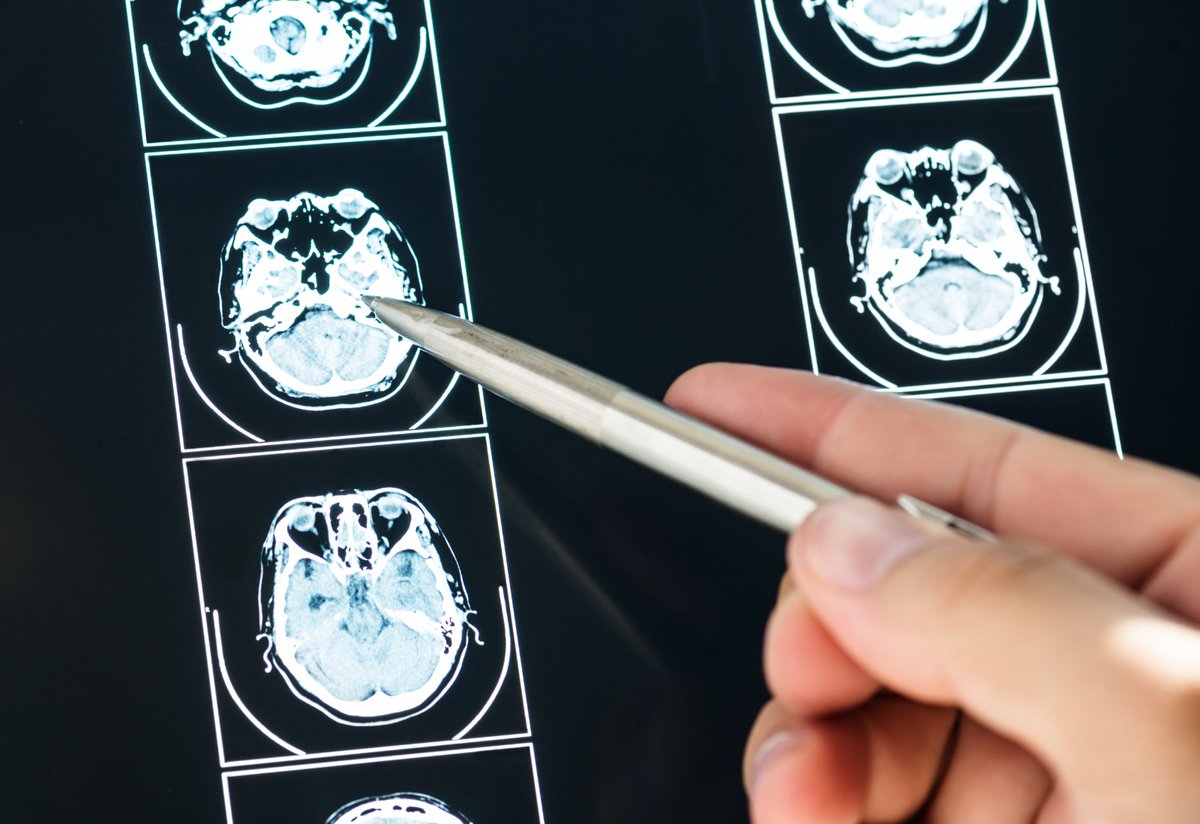 MSPUruguay's tweet photo. A partir de febrero de 2023 se suma a las prestaciones del Fondo Nacional de Recursos la embolización de aneurismas cerebrales, anunció el ministro de Salud Pública, @DrDanielSalinas.

➡️ https://t.co/zGVnaSccJf https://t.co/K6bLmKhfZi