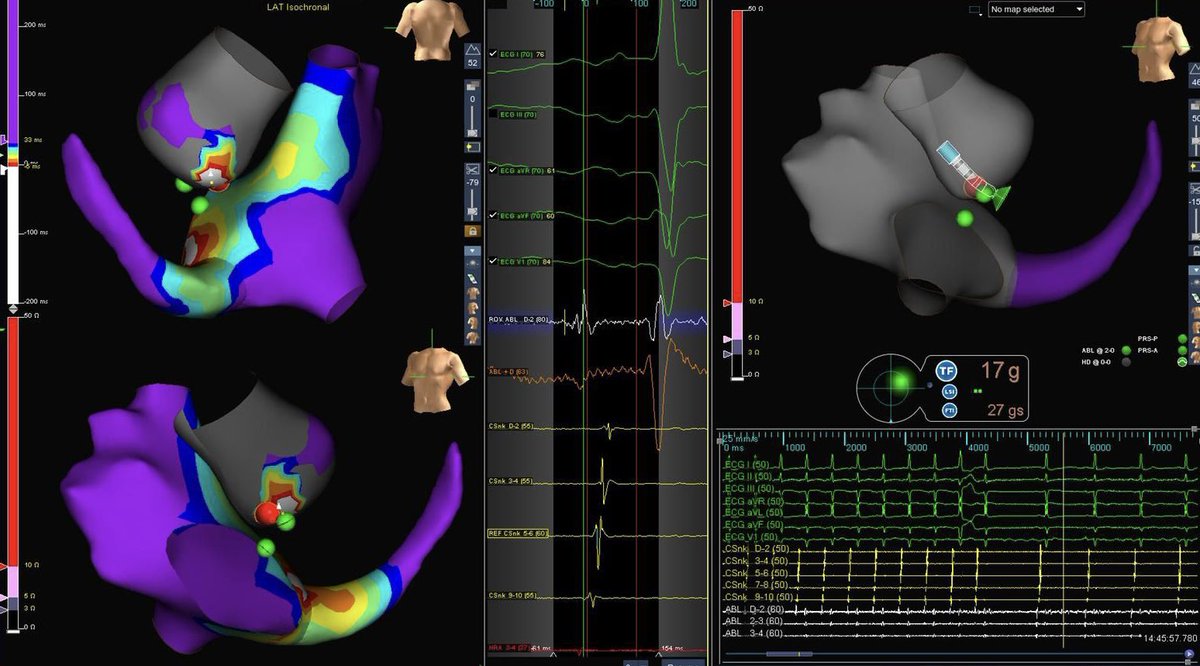 Jordan Hemmen (@jordinarymaps) on Twitter photo Termination of incessant AT, localized to non-coronary cusp corresponding to multiphasic #ECG morphology. <a href="/JaylynnMariePDX/">Jaylynn Markey</a> <a href="/cstumpflEP/">Conley Stumpfl</a> Termination of incessant AT, localized to non-coronary cusp corresponding to multiphasic #ECG morphology. <a href="/JaylynnMariePDX/">Jaylynn Markey</a> <a href="/cstumpflEP/">Conley Stumpfl</a>