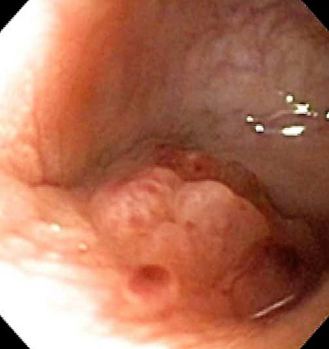 Out lastest contribution: An incidental infiltrating colonic lesion found during colonoscopy in a woman in her 30s.

#MedTwitter @me4_so @SoMe4endoscopy
@HolubarStefan @nlavellaneda
@ScottRSteeleMD

Source: doi.org/10.1111/ans.18…