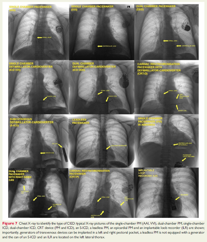 🆕📌 Cómo saber con una radiografía de tórax qué dispositivo implantable tiene mi paciente.

👉 Marcapasos, desfibrilador, resincronizador, holter implantable... sin cables, una cámara, dos cámaras...

🔓 academic.oup.com/europace/artic…
#CardioTwitter #Cardiologia