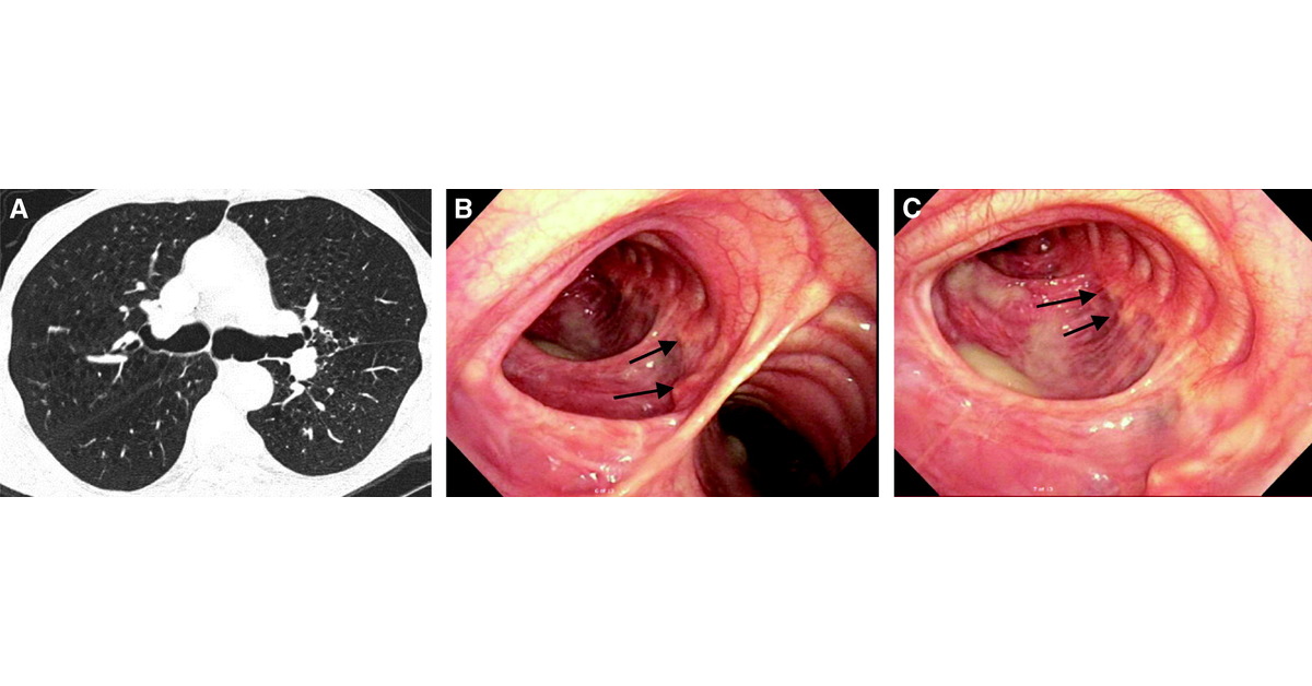 ATSBlueEditor's tweet photo. Tracheobronchial Smooth Muscle Atrophy and Separation

🔗 https://t.co/Uz3ABL3XPJ https://t.co/ts40YZZmPu