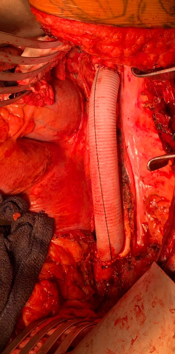 DoctorGreg13's tweet photo. Friday TAA- totally abnormal aorta

39M smoking since age 5 presenting with renovisceral embolism from this shaggy thoracic aorta while on A/C.

Descending aortic replacement on FAFV bypass, celiac thrombectomy (blue loop on celiac)

@KallieRobertsDO @CMC_VascFellows  @theSHVI https://t.co/1d7szDFOB5