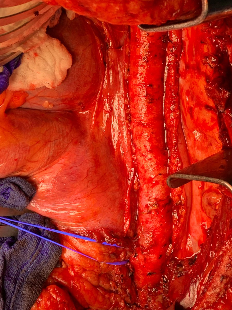 DoctorGreg13's tweet photo. Friday TAA- totally abnormal aorta

39M smoking since age 5 presenting with renovisceral embolism from this shaggy thoracic aorta while on A/C.

Descending aortic replacement on FAFV bypass, celiac thrombectomy (blue loop on celiac)

@KallieRobertsDO @CMC_VascFellows  @theSHVI https://t.co/1d7szDFOB5