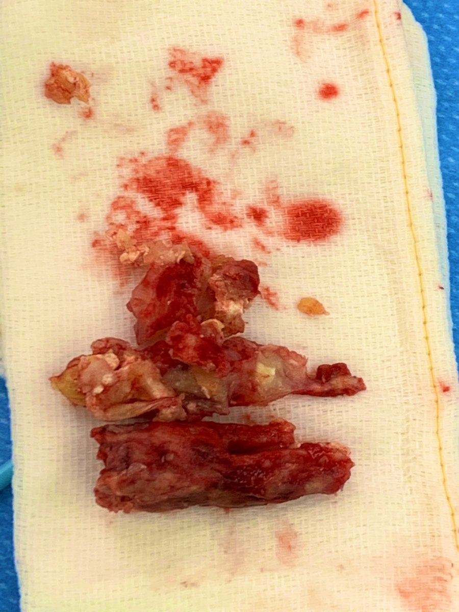 DoctorGreg13's tweet photo. Friday TAA- totally abnormal aorta

39M smoking since age 5 presenting with renovisceral embolism from this shaggy thoracic aorta while on A/C.

Descending aortic replacement on FAFV bypass, celiac thrombectomy (blue loop on celiac)

@KallieRobertsDO @CMC_VascFellows  @theSHVI https://t.co/1d7szDFOB5