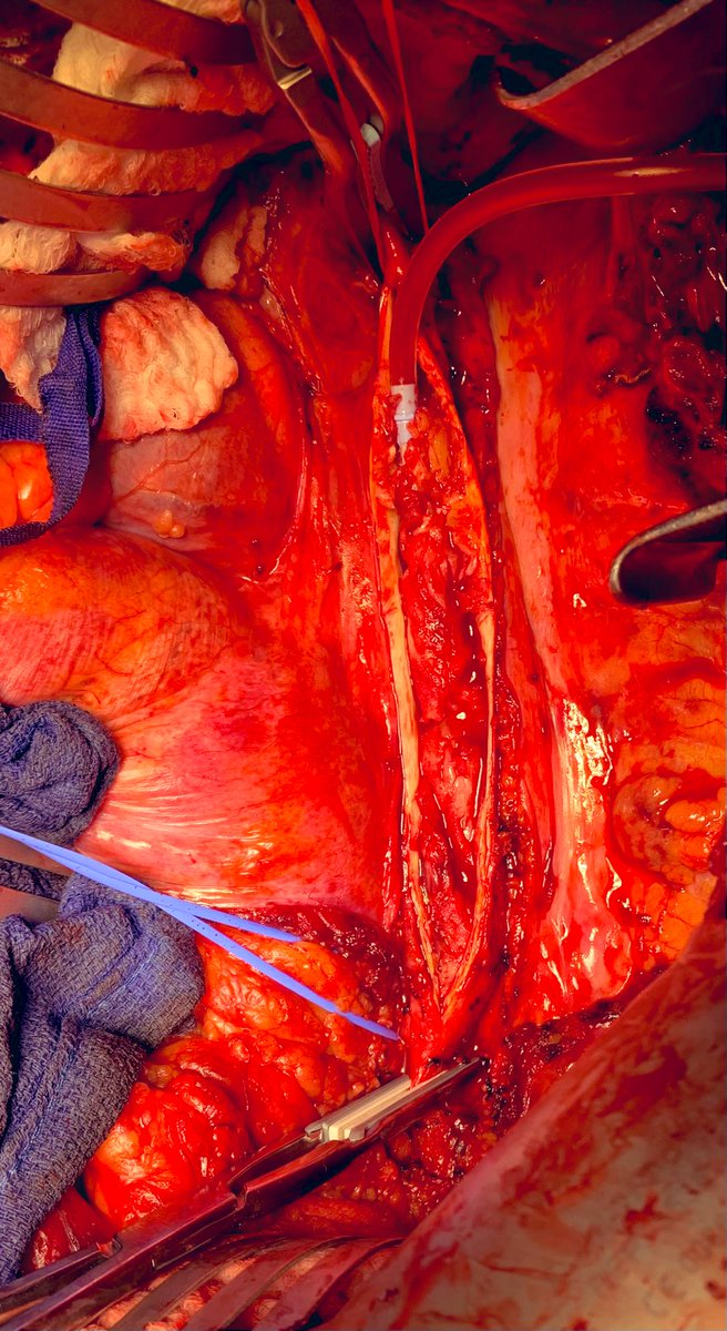 DoctorGreg13's tweet photo. Friday TAA- totally abnormal aorta

39M smoking since age 5 presenting with renovisceral embolism from this shaggy thoracic aorta while on A/C.

Descending aortic replacement on FAFV bypass, celiac thrombectomy (blue loop on celiac)

@KallieRobertsDO @CMC_VascFellows  @theSHVI https://t.co/1d7szDFOB5