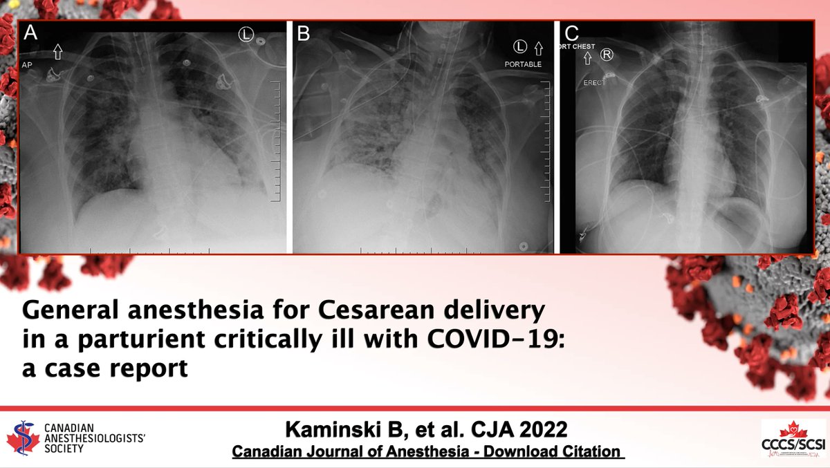 CJA_Journal's tweet photo. General anesthesia for Cesarean delivery in a parturient critically ill with #COVID19: a case report | #OBAnes #CJA2022 #Anesthesia #Anesthesiology   https://t.co/AQdIndB1CY https://t.co/EQPZ5bskVa