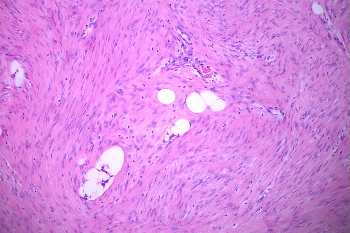 GeronimoJrLapac's tweet photo. F,35yo, Breast nodule.

#breastpath #pathology https://t.co/ZNttzYOiKR