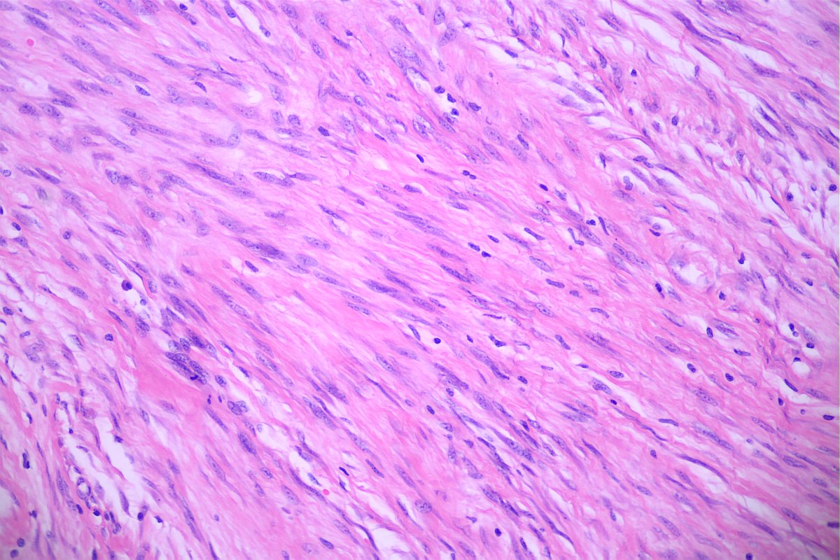GeronimoJrLapac's tweet photo. F,35yo, Breast nodule.

#breastpath #pathology https://t.co/ZNttzYOiKR