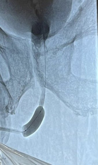 AlexRuebben's tweet photo. First #Urethroplasty in #Italy #Rome with a #DrugCoatedBalloon #ELUTAX3 #ARBalticMedical #ab_medica https://t.co/ya0fLHcDbf