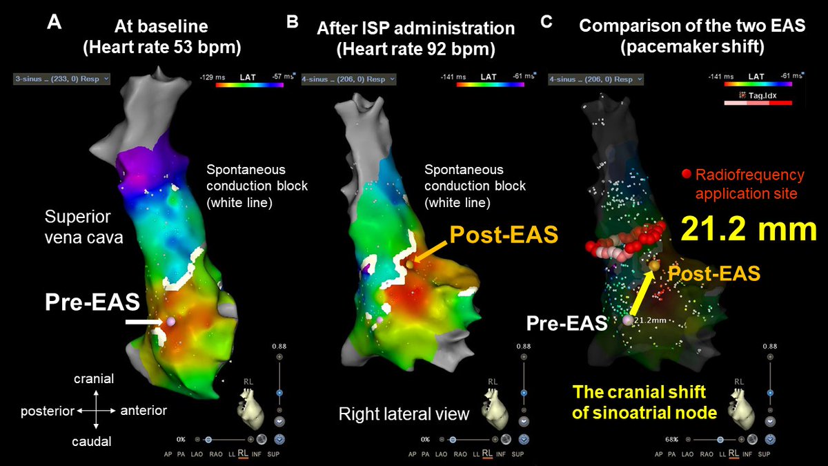 MasatoOkada1105's tweet photo. Congrats, Dr. Iwasa!! We encountered a case that exhibited a notable pacemaker shift (>20 mm) in the sinoatrial node when performing an SVC isolation. Where to create an SVC isolation line remains an important issue.
@CJCJournals #SVCI
https://t.co/xTjOrwB0bt https://t.co/NY14Xbv8q3