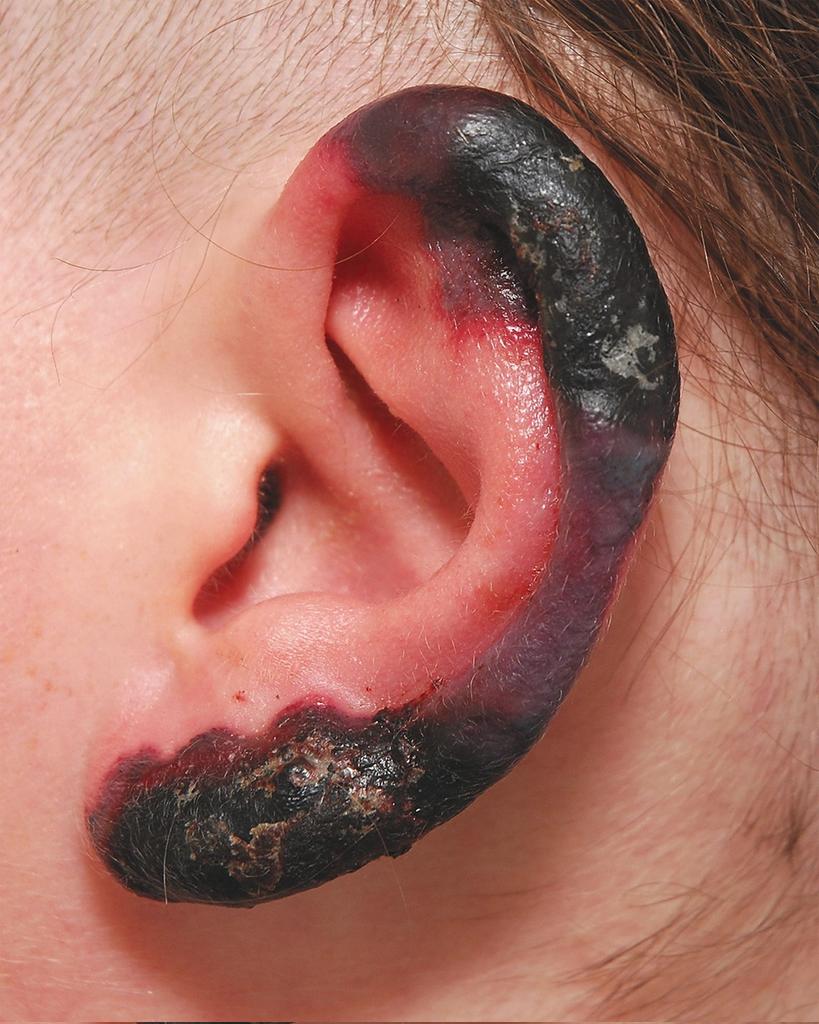 MoreXGrok's tweet photo. A 31-year-old woman 

 👉multiple necrotic skin lesions on her nose, ears, and legs 

👉 developed over a period of a few days https://t.co/uaAG3sf3il