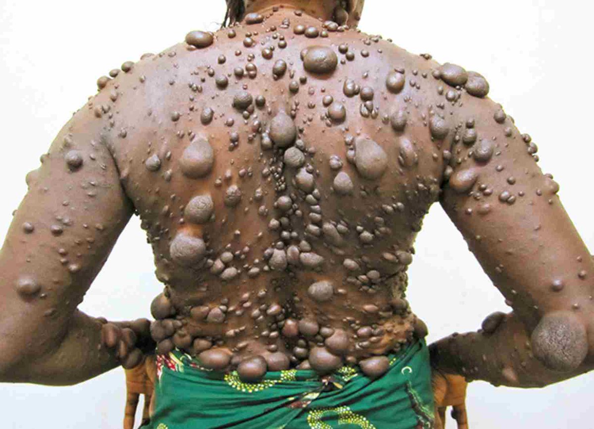 BrownJHM's tweet photo. A 26-year-old woman presented with painless nodular skin lesions that first developed 7 years earlier. Skin nodules initially appeared on the anterior chest wall and progressed to involve the whole body. What is the likely diagnosis? #Medtwitter https://t.co/DB3lIUlTuG