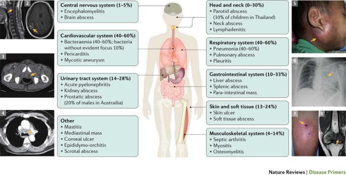 Melioidosis - the great mimicker • Caused by Burkholderia pseudomallei, a GNB found in water and soil • Endemic in SE Asia and N Australia • Dx by culture (serology not reliable) • Treatment: intensive (ceftazidime or meropenem) + eradication phase (TMPSMX or Augmentin)