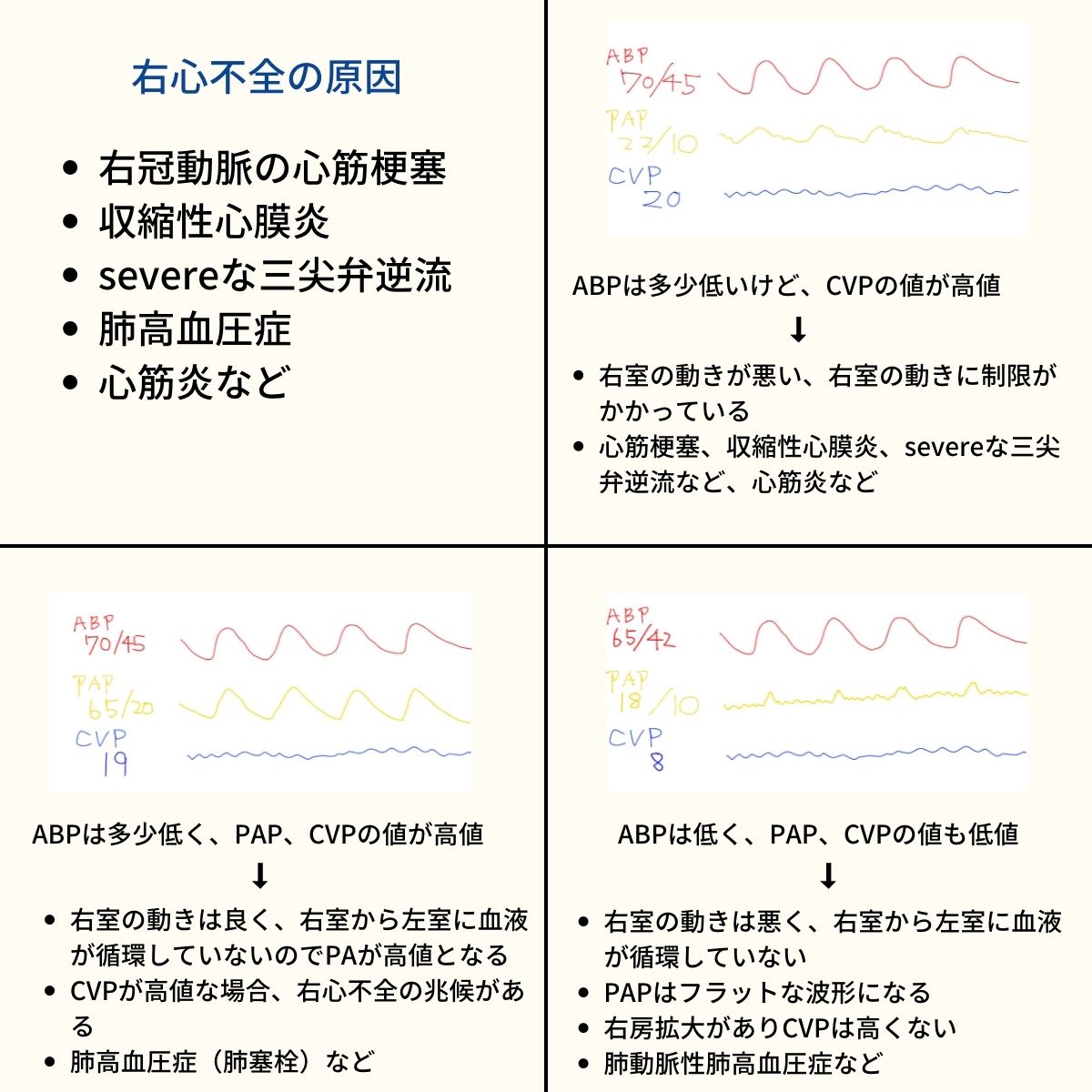 Jcrow_51's tweet photo. 右心不全ってすごく難しい病態だと思います🤔

右心不全の血行動態をイラストの波形をもとに解説！
その他にも病態生理、管理方法を解説していきます📚 https://t.co/JElKQnEUcl