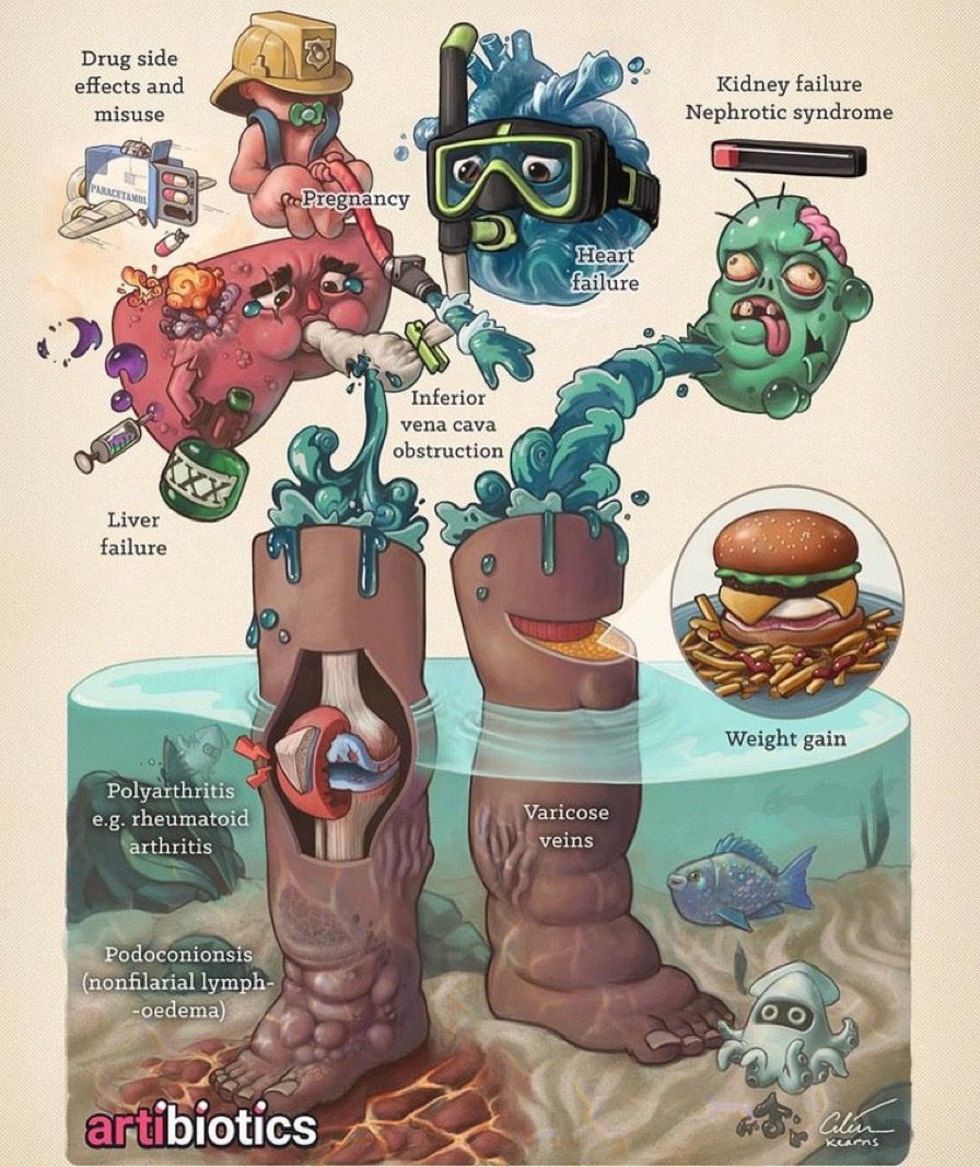 أسباب تجمع السوائل في الاقدام

- تعب الكلى (غازيات واملاح وكثرة منبهات وتدخين وبخور)

- تعب القلب (كثرة اجبان وترك الحجامة)

- تعب الكبد (اعراض جانبية لادوية ودهون وخمر وحلويات)

- تعب الطحال (دوالي وحلويات وجبن)