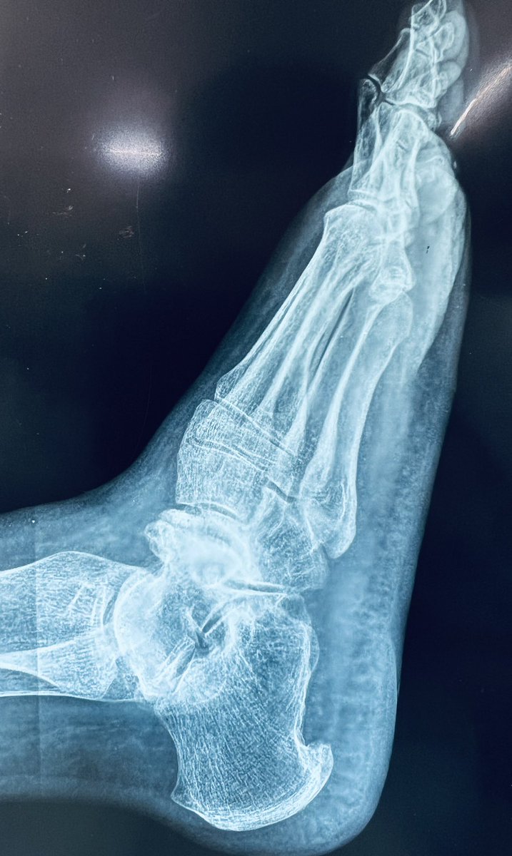 DrPrasadJain's tweet photo. A rare case of #muellerweiss syndrome.
It is an adult onset spontaneous osteonecrosis of navicular bone causing mid and hindfoot pain and deformity
#MedTwitter #rheumatology #radiology #medicine #rarecase #interestingcase https://t.co/jzlWJFozjc