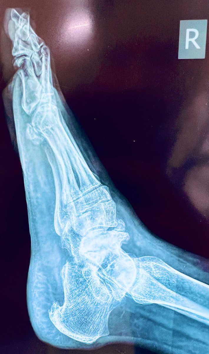 DrPrasadJain's tweet photo. A rare case of #muellerweiss syndrome.
It is an adult onset spontaneous osteonecrosis of navicular bone causing mid and hindfoot pain and deformity
#MedTwitter #rheumatology #radiology #medicine #rarecase #interestingcase https://t.co/jzlWJFozjc