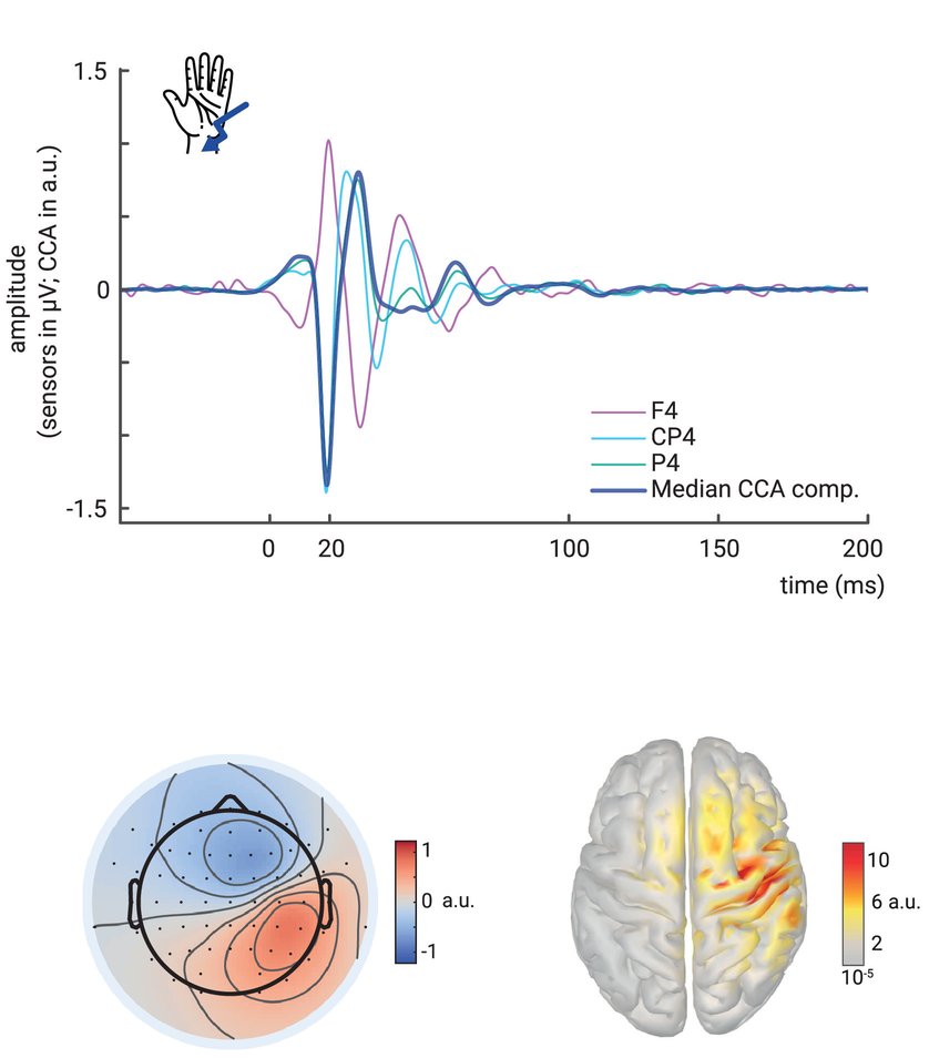 rd pascual-marqui (@pascual_marqui) on Twitter photo Stephani et al: Cortical response variability is driven by local excitability changes with somatotopic organization. NeuroImage. October 2022. In Press.
doi.org/10.1016/j.neur…
<a href="/TilmanStephani/">Tilman Stephani</a>
<a href="/birgit_nierula/">Birgit Nierula</a>
<a href="/arnovillri/">Arno Villringer</a>
<a href="/AcademicEEG/">AcademicEEG</a> Stephani et al: Cortical response variability is driven by local excitability changes with somatotopic organization. NeuroImage. October 2022. In Press.
doi.org/10.1016/j.neur…
<a href="/TilmanStephani/">Tilman Stephani</a>
<a href="/birgit_nierula/">Birgit Nierula</a>
<a href="/arnovillri/">Arno Villringer</a>
<a href="/AcademicEEG/">AcademicEEG</a>