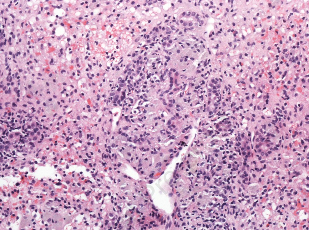 john_damianosMD's tweet photo. Kombucha-induced acute liver injury with massive hepatic necrosis

#MedTwitter #LiverTwitter #Liver #GITwitter #microbiome 

https://t.co/1NBcVWdNQQ https://t.co/hGI5TtNffB