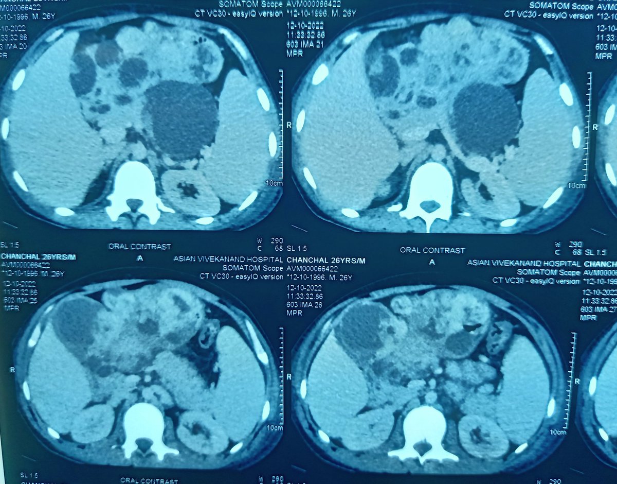 akm_ipl's tweet photo. #Surgicalcase
#GISurgery 🥼⚕️🩺
26 male with chronic anemia and history of malena since last few yrs no h/o wt loss or loss of appetite, per abdomen no any palpable mass,CECT s/o 15x15 mass with intragastri & extragastric component,UGI Endoscopic Bx done, provisional diagnosis??? https://t.co/0zLdcRs0Sw