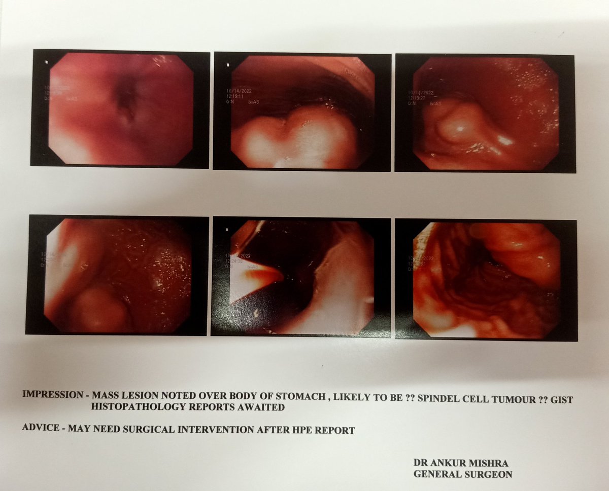 akm_ipl's tweet photo. #Surgicalcase
#GISurgery 🥼⚕️🩺
26 male with chronic anemia and history of malena since last few yrs no h/o wt loss or loss of appetite, per abdomen no any palpable mass,CECT s/o 15x15 mass with intragastri & extragastric component,UGI Endoscopic Bx done, provisional diagnosis??? https://t.co/0zLdcRs0Sw