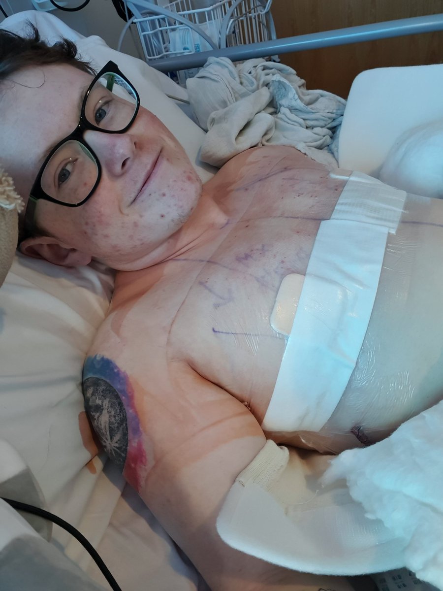 I just woke up from surgery and... Y'all, you have no idea how happy I am right now, so far from what I can tell my chest looks so good and my breasts are ACTUALLY GONE!!!!!!

#transgender #ftm #topsurgery #surgery #transgendersurgery #doublemastectomy