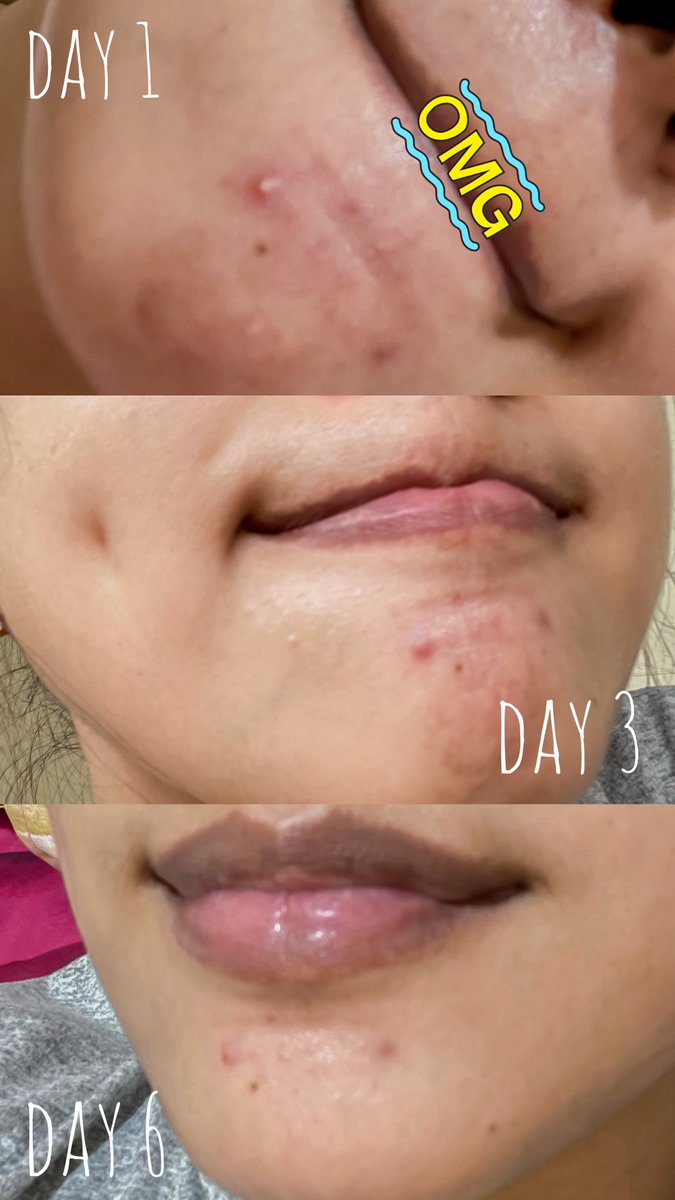 ayubsr's tweet photo. sebel kan sama bekas jerawat yang susah bgt diilangin?
seneng banget skincare aku yang satu ini kayak Anya Geraldine wkwk😆, bisa jadi solusi dari #Drawat alias Drama Jerawat ini!
liat kan perbedaannya? aku buktiin sendiri🫶🏻 https://t.co/elfFndEIvM