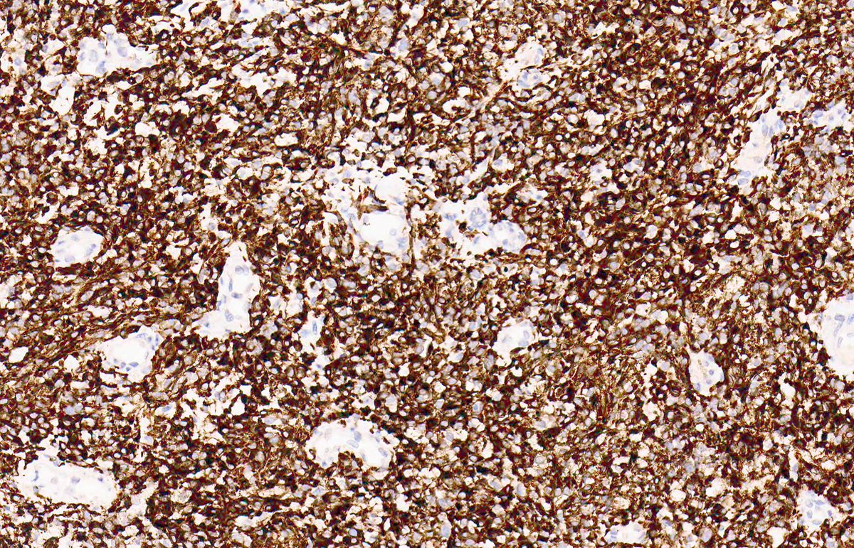 DESMOPLASTIC SMALL ROUND CELL TUMOUR. IHC: desmin. NGS: EWSR1::WT1. NB: sheets of polygonal-spindle cells; eosinophilic cytoplasm; monomorphic round-ovoid nuclei; occasional thin collagen bands; ~ one third of cases lack 'conventional' histological features (PMID: 9808123).