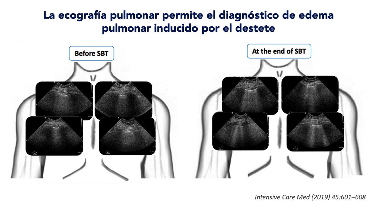 job_rdz's tweet photo. 🔺 Como diagnostico el EAP asociado a Retiro (WiPO)❓
🫁 𝐋𝐔𝐒: La aparición de nuevas líneas B tras una SBT Predice 𝗪𝗶𝗣𝗢.
🤔 que tantas❓
R: Delta de 6
#COMMEC2022 🇲🇽 #MedCritMx #FOAMex https://t.co/jMuSO4fFNl