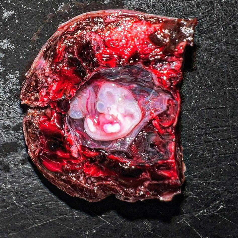 ClevesMario's tweet image. Cross section of the tube intraluminal gestational sac. Embryo is visible. Ectopic / tubal pregnancy at 7 weeks pregnant.

#medicine #anatomy #medschool #pathology #histology #medlife #histologia #path #pathologists