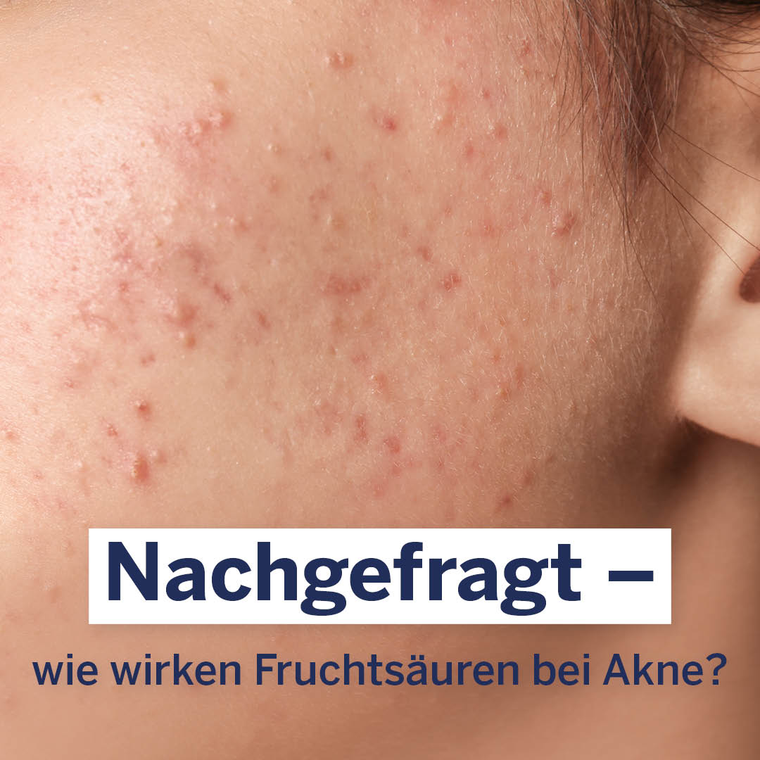 #Fruchtsäure bei fettiger, zu #Akne neigender Haut? 🤔Yes! So können Fruchtsäuren bei Akne wirken: 👉 Hornlösend. Talgregulierend und hautklärend. Zellerneuernd. Desinfizierend. 💡 Wir empfehlen dir unser Seborra Hautklärendes Serum und die #Seborra Hautklärende Körperlotion.