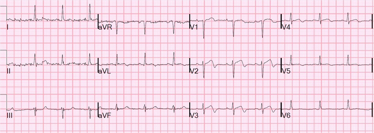 smithECGBlog's tweet photo. @adribaran @The_Nanashi_O @DJAPRN @EcgOxford @MaruanCarlos @ShariqShamimMD @UlhasDr @DidlakeDW @ecgrhythms @syamkumarmd @kkananura @DrRajeshG1 @DocNikko @AslangerE @martinfd78 @Vadeboncoeur_Al @EM_RESUS @EMS12Lead @DruvBhagavan 4/x  See this ED ECG after resolution of chest pain.  It is diagnostic of Wellens'.   We had to go seek out to see if there had be a prehospital ECG.  There was.  Wellens' really is "Transient STEMI or OMI" with spontaneous reperfusion.  You can't find a case to refute this. https://t.co/dkvwTz6jFs