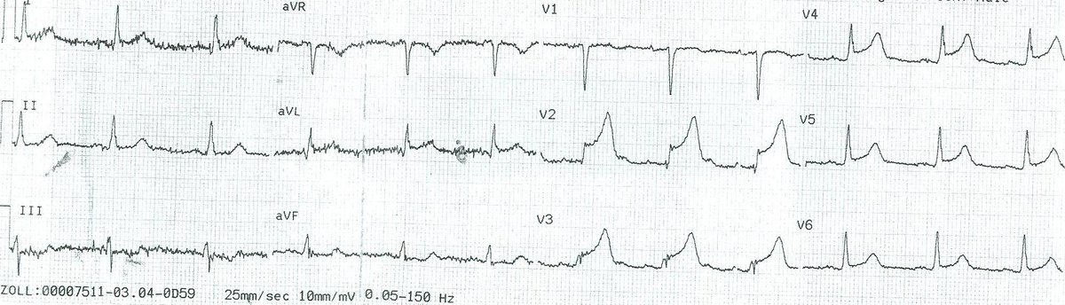 smithECGBlog's tweet photo. @adribaran @The_Nanashi_O @DJAPRN @EcgOxford @MaruanCarlos @ShariqShamimMD @UlhasDr @DidlakeDW @ecgrhythms @syamkumarmd @kkananura @DrRajeshG1 @DocNikko @AslangerE @martinfd78 @Vadeboncoeur_Al @EM_RESUS @EMS12Lead @DruvBhagavan 4/x  See this ED ECG after resolution of chest pain.  It is diagnostic of Wellens'.   We had to go seek out to see if there had be a prehospital ECG.  There was.  Wellens' really is "Transient STEMI or OMI" with spontaneous reperfusion.  You can't find a case to refute this. https://t.co/dkvwTz6jFs