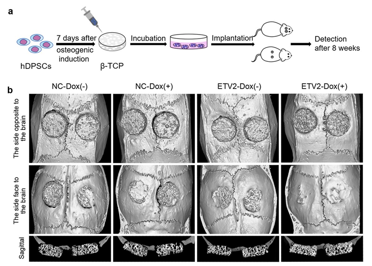 MesenchymalCell's tweet image. Researchers from Anhui Medical University evaluated the effects of Dox-induced overexpression of Ets variant 2 on the #osteogenesis of human dental 🦷 pulp stem cells.

Read more here:
➡️ bit.ly/3et4KP7