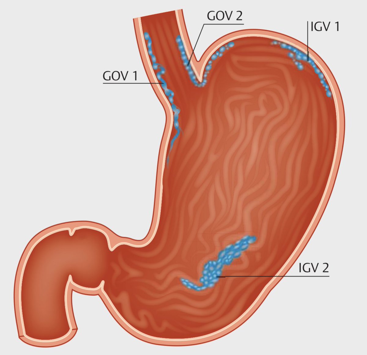 drkeithsiau's tweet photo. ESGE 2022 variceal bleeding guidelines 🆕🩸 #MedEd #LiverTwitter

1️⃣ Definitions
2️⃣ Sarin classification of GVs
3️⃣ Mx of bleeding OVs 
4️⃣ Mx of bleeding GVs

https://t.co/p9GwPshpoZ https://t.co/XpH5L1QSsv