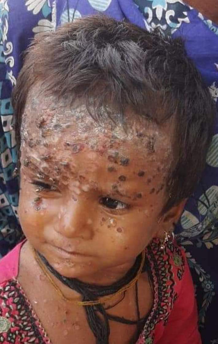 BuriroSadam1's tweet photo. As a result of flood water, malaria, diarrhea, and skin diseases are on the rise. There are thousands of children dying from diseases, expecting mothers are suffering, The authorities are sleeping, corruption is rampant, and no one is paying attention!
#FixSindhDrianage https://t.co/8YSbxqcBmH