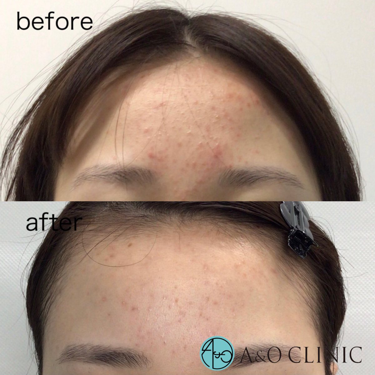 aoclinic_o's tweet photo. ケミカルピーリング３回症例写真🤳

全体的にニキビの個数が減り、細かくなってきました☝️強い赤みも最初はありましたが軽減されてきています☺️

【注意事項】
・ピーリング後は一時的に赤みが出ることがあります。
・皮下気泡(白い点状)が出現することもあり。

ケミカルピーリング
初回 ¥5,000〜 https://t.co/nRc3TPYYGF